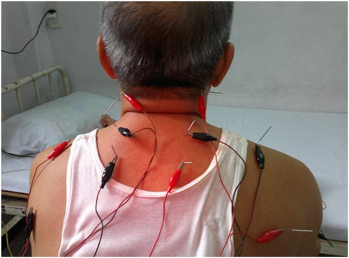 Điện châm điều trị các chứng đau - Hiệu quả và tiết kiệm